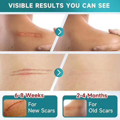Silicone Scar Remover Tape for Acne & Wrinkles