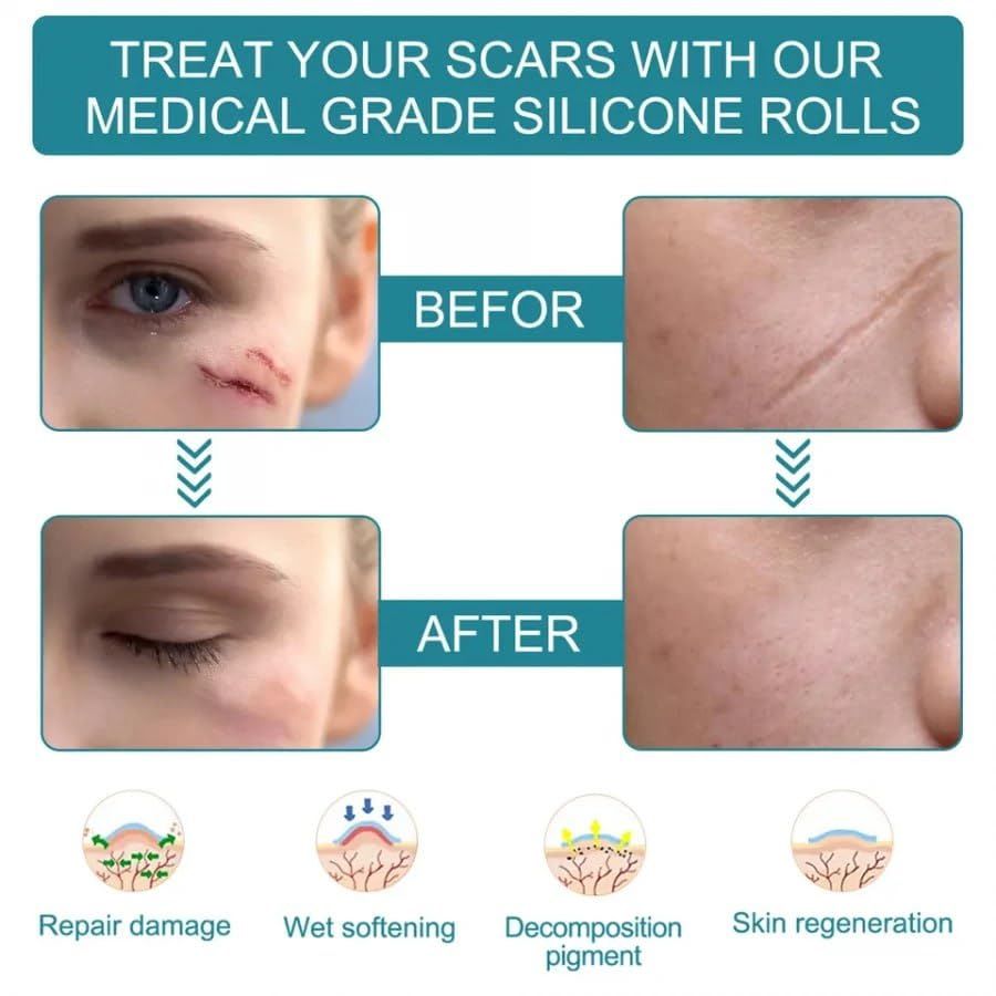 Silicone Scar Remover Tape for Acne & Wrinkles
